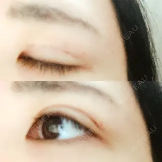 5日目の経過画像（1枚目）