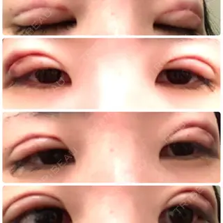 0日目の経過画像（1枚目）