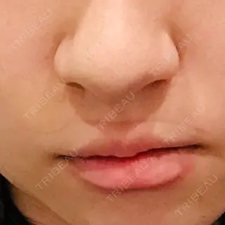5日目の経過画像（1枚目）