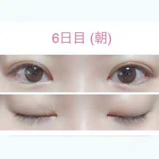 6日目の経過画像（1枚目）