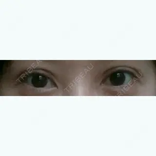 2日目の経過画像（1枚目）