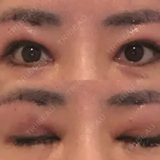1日目の経過画像（1枚目）