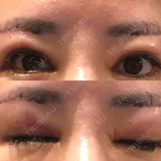 2日目の経過画像（1枚目）