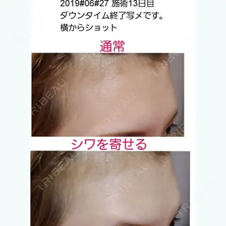 13日目の経過画像（2枚目）