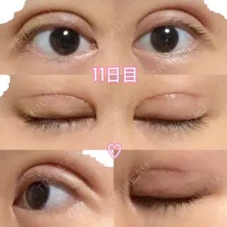 10日目の経過画像（1枚目）