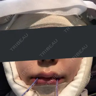 0日目の経過画像（1枚目）