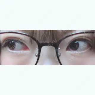 0日目の経過画像（2枚目）