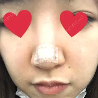 0日目の経過画像（3枚目）