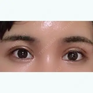 37日目の経過画像（1枚目）