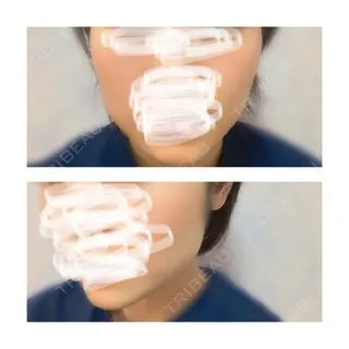 5日目の経過画像（1枚目）