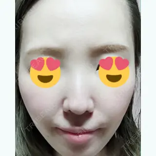 9日目の経過画像（1枚目）