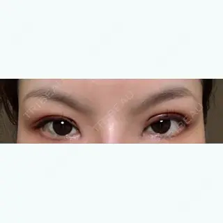 0日目の経過画像（1枚目）