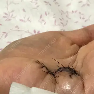 8日目の経過画像（3枚目）