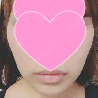 35日目の経過画像（1枚目）