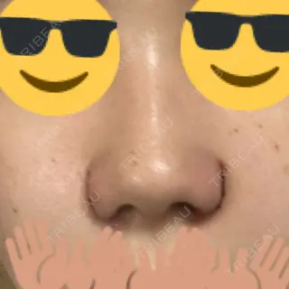2日目の経過画像（1枚目）
