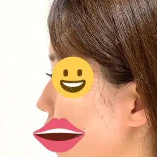 30日目の経過画像（1枚目）