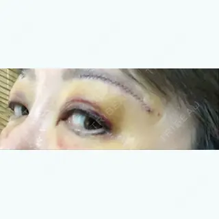 4日目の経過画像（3枚目）