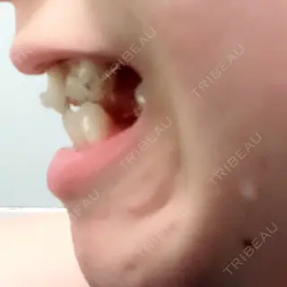 1日目の経過画像（2枚目）