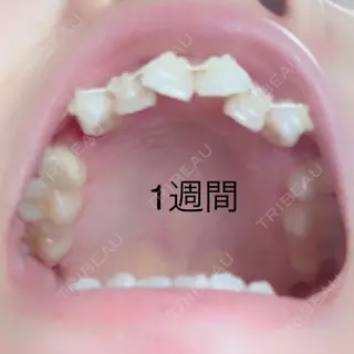 7日目の経過画像（3枚目）