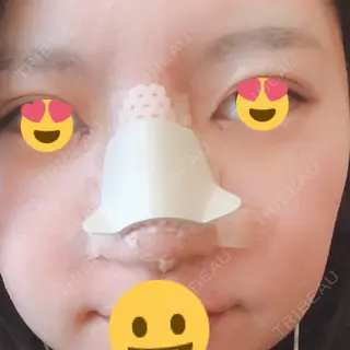 4日目の経過画像（1枚目）