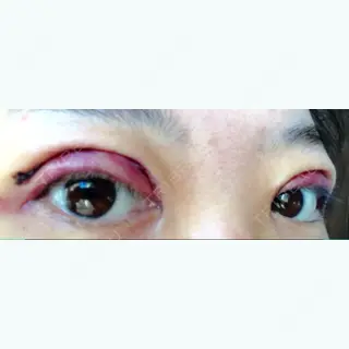 3日目の経過画像（1枚目）