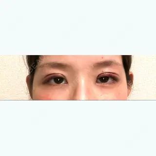 0日目の経過画像（2枚目）