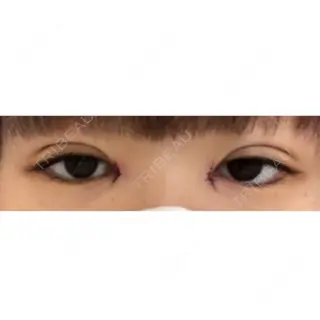 0日目の経過画像（1枚目）