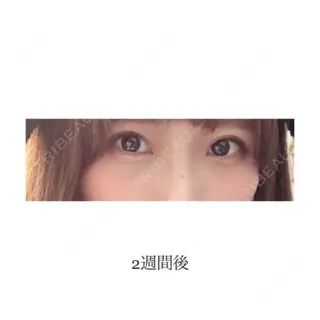 14日目の経過画像（1枚目）