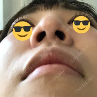 10日目の経過画像（3枚目）