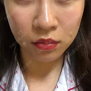 1日目の経過画像（1枚目）