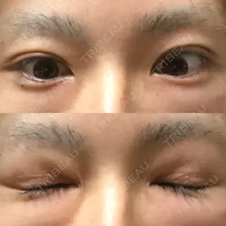 69日目の経過画像（1枚目）
