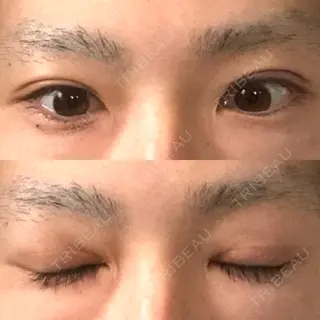 70日目の経過画像（1枚目）