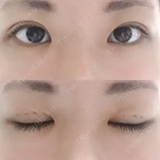 5日目の経過画像（1枚目）