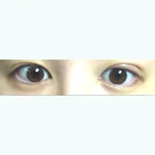 1日目の経過画像（1枚目）