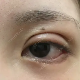 15日目の経過画像（2枚目）
