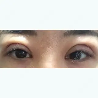 0日目の経過画像（1枚目）
