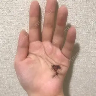 13日目の経過画像（1枚目）