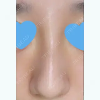 2日目の経過画像（1枚目）