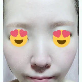 17日目の経過画像（1枚目）