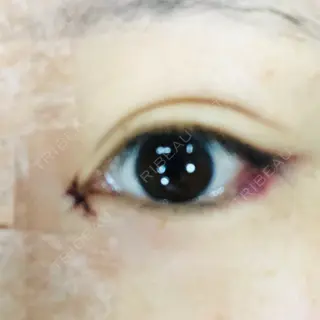 1日目の経過画像（3枚目）
