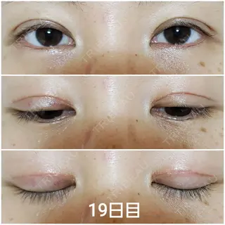 19日目の経過画像（1枚目）
