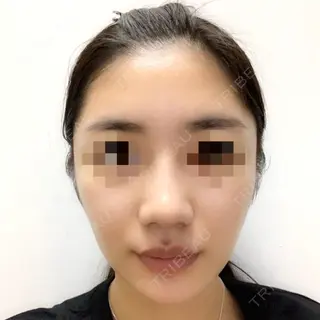 23日目の経過画像（1枚目）
