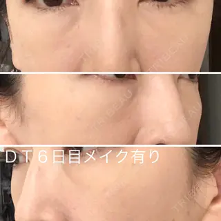 6日目の経過画像（2枚目）