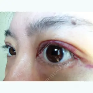 12日目の経過画像（1枚目）