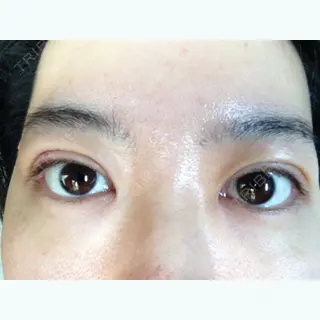 31日目の経過画像（1枚目）