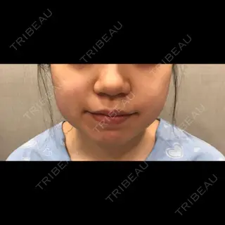 0日目の経過画像（2枚目）