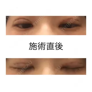 0日目の経過画像（1枚目）