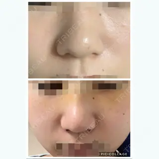 4日目の経過画像（3枚目）