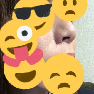 30日目の経過画像（2枚目）
