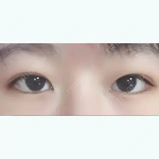 5日目の経過画像（1枚目）